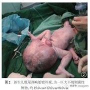 孕期畸胎瘤（孕期畸胎瘤）