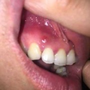 孕期牙齿肿痛（孕期牙齿肿痛,牙肉都肿了）