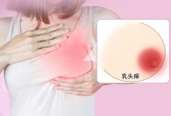 怀孕期间奶头痒（怀孕中期乳头痒怎么回事）