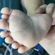 胎儿多脚趾（孩子脚趾遗传爸爸还是妈妈）