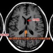 正常成人大脑中存在帆腔吗,胎儿大脑中帆腔怎么办