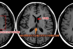 正常成人大脑中存在帆腔吗,胎儿大脑中帆腔怎么办