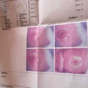 怀孕期间宫颈糜烂（中度宫糜烂对胎儿有应响）