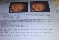 大排畸什么念,大排畸异常的胎儿征兆有哪些