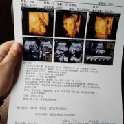 怀孕33周，还能做胎儿心脏彩超吗,四维过了有必要做心脏彩超吗
