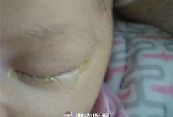 5个月宝宝眼睛眼屎多,怀孕五个月胎儿有多重