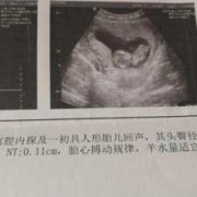 胎儿头小是什么原因（宝宝现在刚满月，头上有头伽怎么回事，要怎么去除）