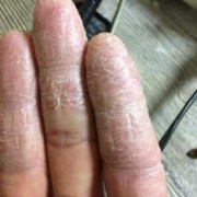 孕期手脱皮（孕期手脱皮是什么原因导致的）