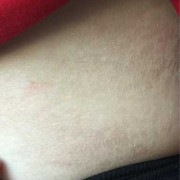 孕期乳头蜕皮（乳头脱皮痒是怎么回事）