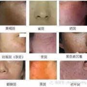 孕期黑色素沉淀严重（皮肤黑色素沉淀怎么办?有什么办法可以去除的）