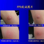 怀孕后能做肺结核皮试吗,孕期肺结核会影响胎儿吗