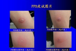 怀孕后能做肺结核皮试吗,孕期肺结核会影响胎儿吗