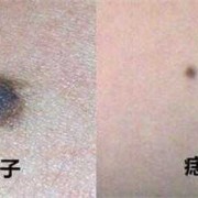 怀孕期间长痣（怀孕期间长痣什么原因）