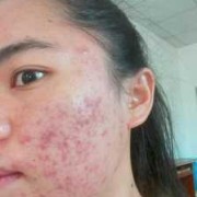 孕期挤痘痘（孕妇脸上长了很多痘痘，里面有些脓，挤掉以后可以用酒精消炎吗）