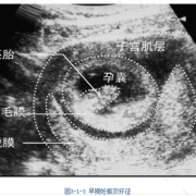 胎儿声像图（胎儿声像图是什么意思）