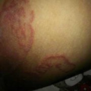 孕期腿部瘙痒（大腿瘙痒尤其是晚上）