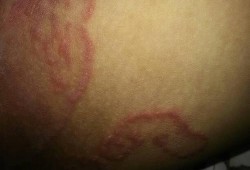 孕期腿部瘙痒（大腿瘙痒尤其是晚上）