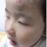 怀孕胎儿靠左边（3岁小孩孩子头左侧中部摔了个大包怎么办）