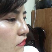 彭体隆鼻+耳软骨鼻尖一个月鼻头很硬正常么,孕期鼻子变硬怎么回事