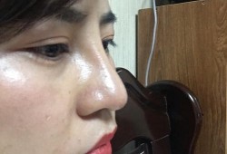 彭体隆鼻+耳软骨鼻尖一个月鼻头很硬正常么,孕期鼻子变硬怎么回事
