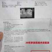 怀孕后检查出子宫肌瘤有影响吗,怀孕期间查出子宫肌瘤危险吗