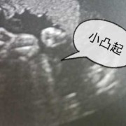 胎儿两腿之间有亮点（胎儿两腿之间有亮点是男孩吗）