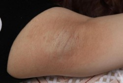 孕期腋臭（孕期腋臭）