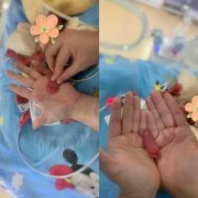 刚出院的婴儿洗澡的正确步骤,草鞋足胎儿的图片