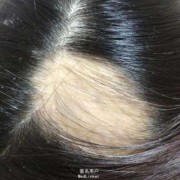 孕妇掉头发正常吗,孕期斑秃的原因和治疗方法
