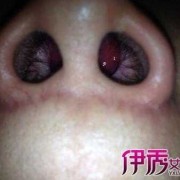 孕期息肉（孕期鼻息肉怎么办）