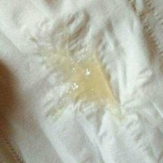 孕期流粘液（孕妇流粘液）