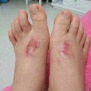 孕期湿疹是如何引起的（孕妇脚上会有湿疹是怎么回事）