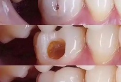 孕妇补牙会影响胎儿吗（孕妇补牙会影响胎儿吗）