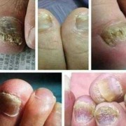 灰指甲怎么能治好,孕期能治疗灰指甲吗