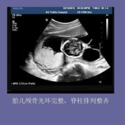 胎儿颅骨光环是什么（胎儿颅骨光环是什么意思）