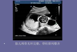 胎儿颅骨光环是什么（胎儿颅骨光环是什么意思）