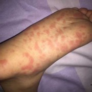 怀孕期间脚上长红点点（怀孕后手心脚心发热是怎么回事？怀孕后手心脚心发热是正常的吗）