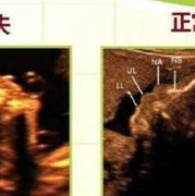 鼻骨短是什么意思,24周胎儿鼻骨长标准对照表