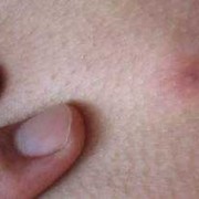 怀孕期间外阴长了疙瘩（孕晚期阴部长了一堆像水泡的疙瘩，怎么回事）