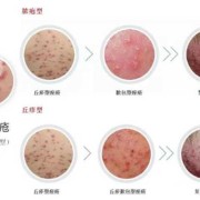 孕期长痘痘怎么办（孕期长痘痘怎么办最快消除）