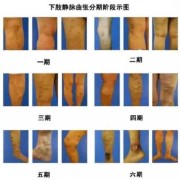 孕期外阴静脉曲张（怀孕五个多月大腿出现了静脉曲张怎么办）