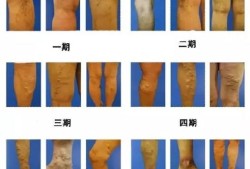 孕期外阴静脉曲张（怀孕五个多月大腿出现了静脉曲张怎么办）