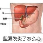 孕期胆囊炎（孕期胆囊炎犯了怎么办）