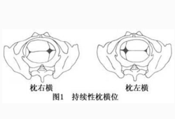 胎儿进入骨盆图片（胎儿为什么会横位）