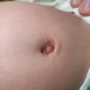 脐带囊肿对胎儿的影响（十个顺产九个有囊肿什么意思）