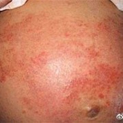 孕期私处湿疹怎么办（阴部湿疹要如何治疗）