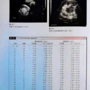 孕36周胎儿肠管扩张该怎么办,32周胎儿肠管扩张正常范围