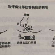 孕期痔疮怎么缓解（孕妇得了痔疮，便后一直流血，该怎么止血呢）