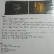 婴儿脊柱裂的症状有什么,胎儿脊柱裂超声表现报告单