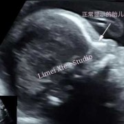宝宝在肚子里喜欢趴着睡觉怎么办,胎儿趴着睡觉b超图